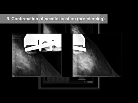 Biópsia por Tomossíntese FUJIFILM Amulet Innovality