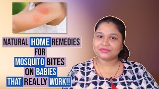 Natural Home Remedies for Mosquito Bites on Babies That Work !!