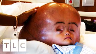 Child&#39;s Fluid-Filled Head Is 3 Times The Size It Should Be | My Baby&#39;s Head Keeps Growing