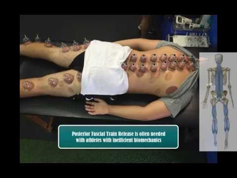Cupping Therapy for Athletes