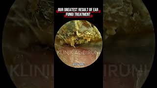 Download lagu Our GREATEST Result of Ear Fungi Treatment (2 months after treatment) mp3 Download lagu Our GREATEST Result of Ear Fungi Treatment (2 months after treatment) mp3