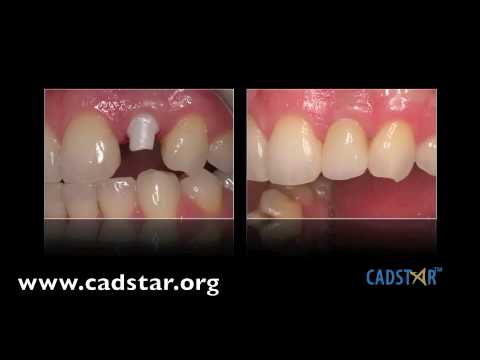 Practical Aesthetic & Functional CAD/CAM Dentistry.m4v