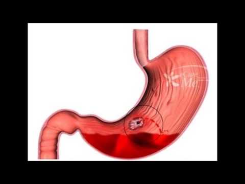 Upper Gastrointestinal Bleeding - Cause and Management