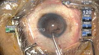 Micro Cataract Surgery (full video)