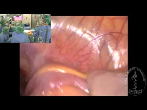 Transvaginal Nephrectomy - Liver Retraction 