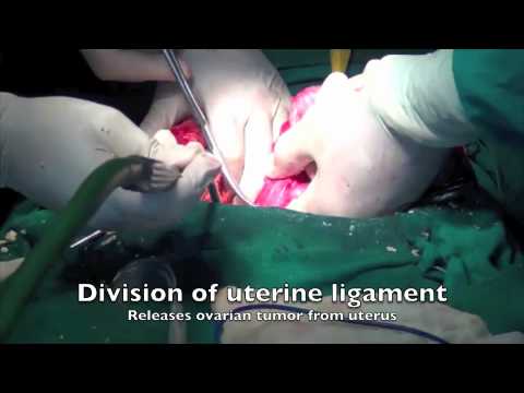 Ovarian Tumor Removal Dermoid Cyst - Teratoma