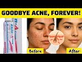 Face Acne Why It Happens How To End It For Good Doctor Based Guide