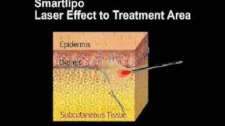 SmartLipo