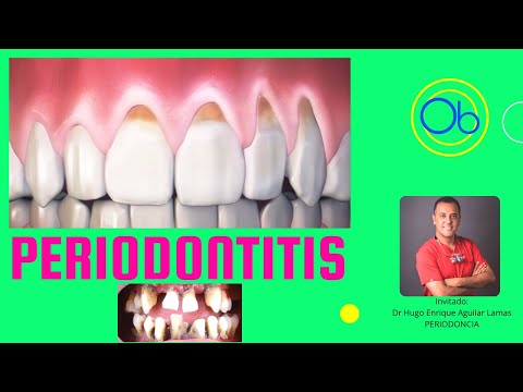 PERIODONTITIS