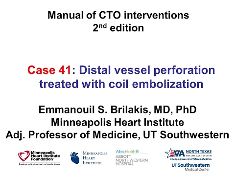 Case 41: Manual of CTO interventions - Distal vessel perforation treated with coil embolization
