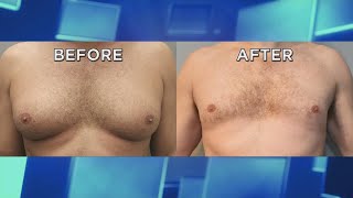 How ‘Man Boobs’ Can Be Treated Non-Surgically