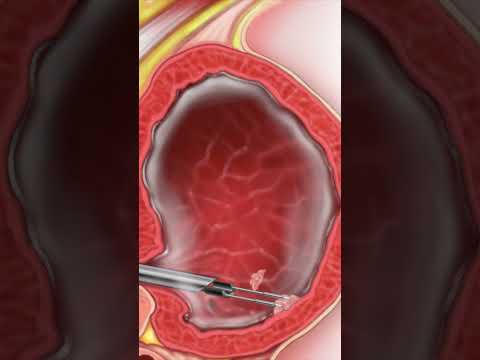 TURBT: Transurethral Resection of Bladder Tumor - Why is it done?  #BladderCancer #Surgery #shorts