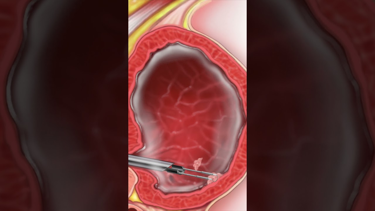 TURBT: Transurethral Resection of Bladder Tumor - Why is it done?  #BladderCancer #Surgery #shorts