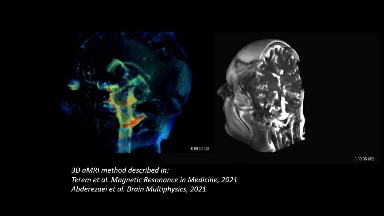 3D aMRI CSF and whole brain - YouTube