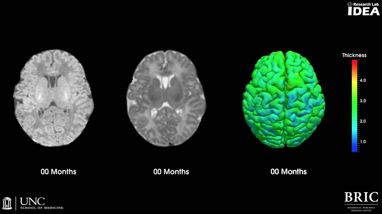 Brain development image progression