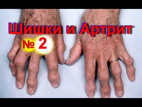 Хондроз шеи лечение отзывы Лечение грыжи позвоночника черкассы