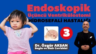 Endoskopik Üçüncü Ventrikülostomi: Minimal İnvaziv Bir Yaklaşım - Bölüm 3 - Dr. Özgür Akşan