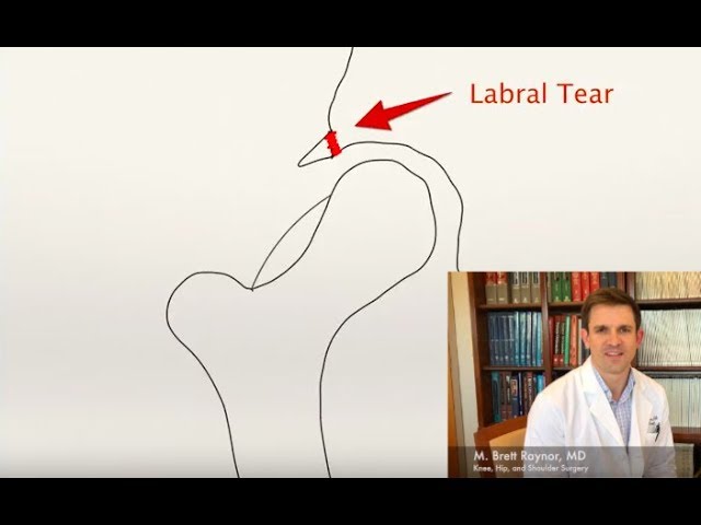 Hip Impingement (FAI) and Labral Tears Explained