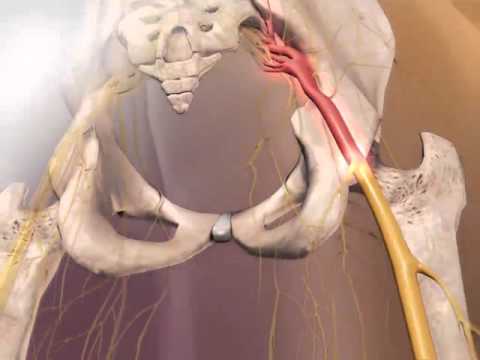 Sciatica: Learn@Visible Body