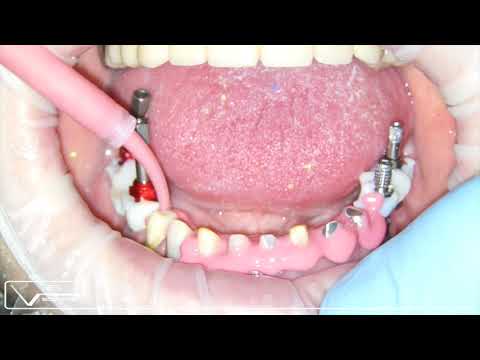 Сочетанное протезирование на зубах и на имплантатах.