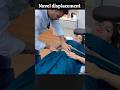 Navel Displacement Treatment In India By Dr Harish Grover Trend Ytshort Shortfeed