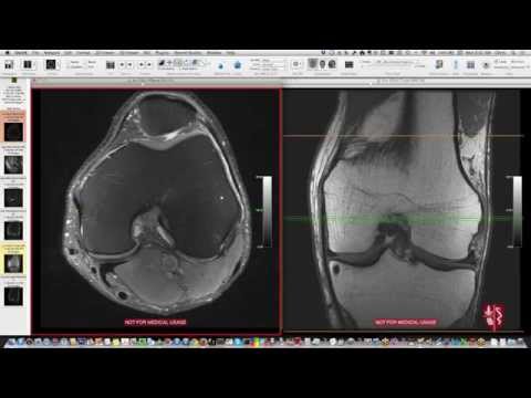Systematic Interpretation of Knee MRI: How I do it