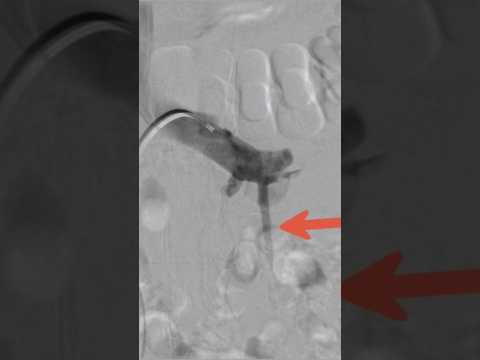 Varicocele embolization live case - Step 4 | Dr. Gaurav Gangwani