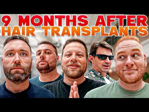 I Helped Them Get Hair Transplants… Here’s What They Look Like Now! | BALDSTOOL REUNION