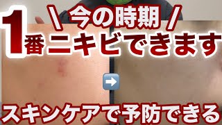 【ニキビ】夏が1番ニキビできます。スキンケアで対策できるぞ