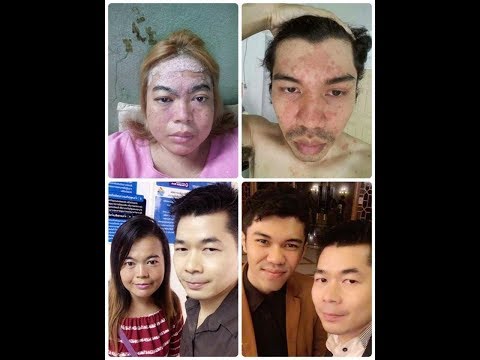 ถ้าหูโรคสะเก็ดเงินว่าจะดู โรคสะเก็ดเงิน, เฟสที่เป็น