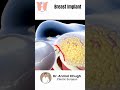 Breast Implant Surgery How It S Done Dr Anmol Chugh