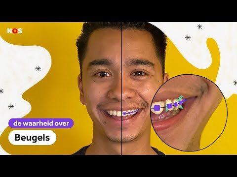 Zijn al die BEUGELS écht NODIG? | De waarheid over rechte tanden