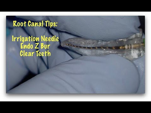 Root Canal Tips:  Endo Z Bur, Irrigation Needles and Plastic Teeth