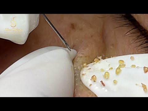 Loan Nguyen Acne Treatment (#151)