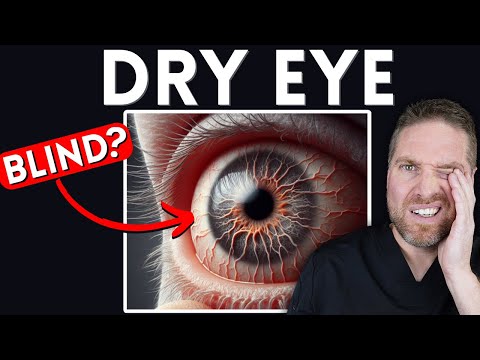 6 Ways Dry Eyes Can Affect Your Eyes And Vision! (Can You Go Blind?)