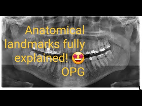 OPG   Detailed Explanation Of Anatomical Landmarks