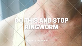 Preventing Ringworm in Humans.| how to get rid of ringworm scars