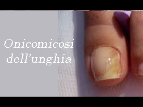 Impianti per cura di psoriasi Le celebrità russe che hanno la psoriasi