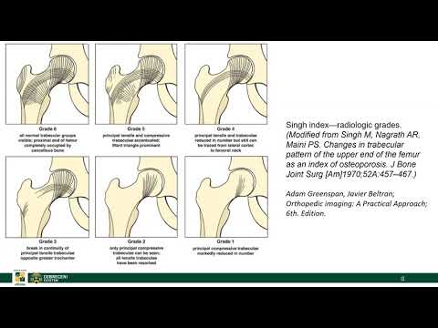 A csípőízület deformáló artrózisának jelei 2 fokkal