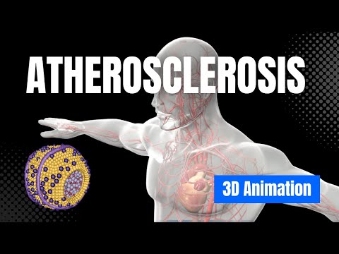 Learn about Atherosclerosis - 3D Animation