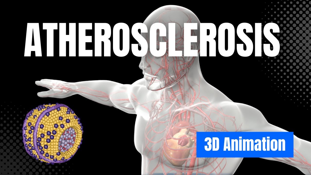 Learn about Atherosclerosis - 3D Animation