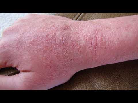 Celiac Disease and How Gluten Affects Your Skin EP011