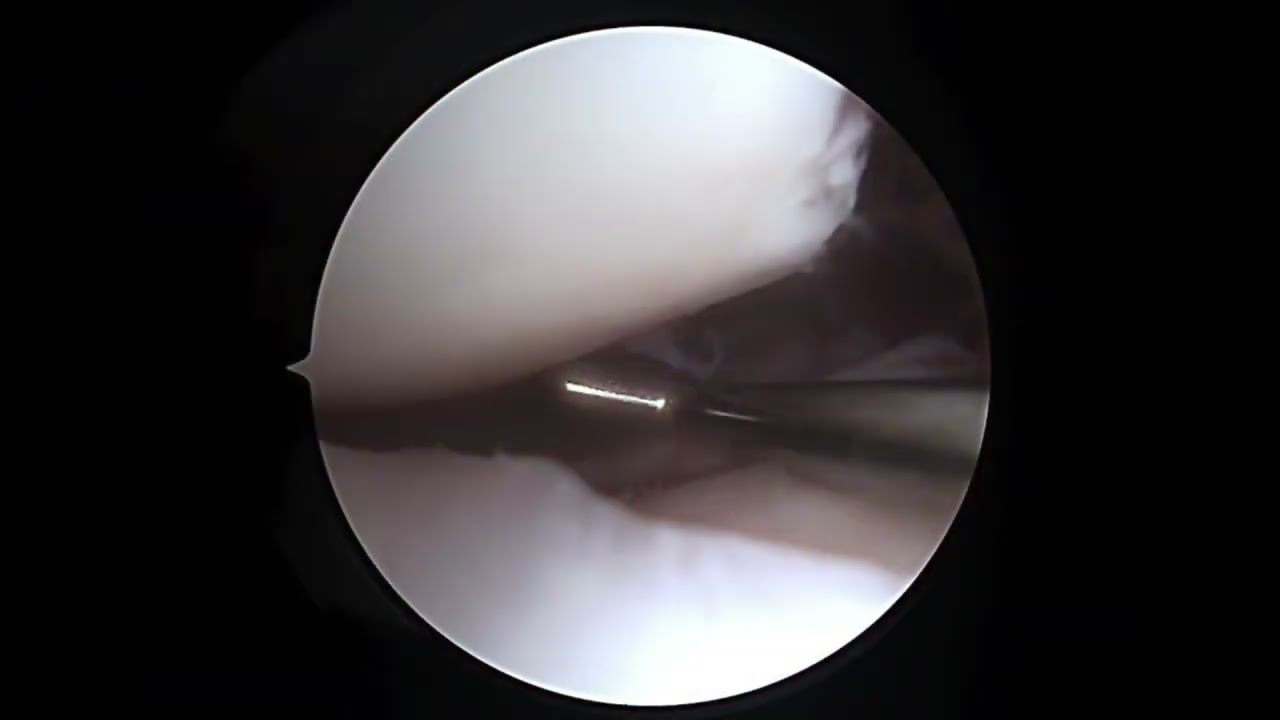 Dr. Garcia demonstrates his updated PLC reconstruction techniques with an ACL/PCL/PLC reco...