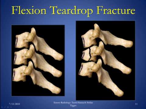 Cervical Spine Fractures Version 1 0