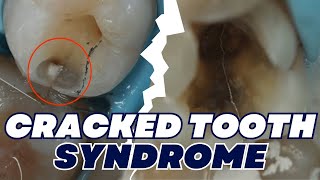 Understanding Cracked Tooth Syndrome and the Dental Occlusion Triad - PS019