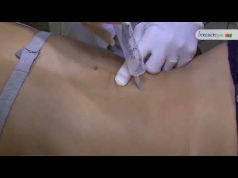Tè da osteocondrosi di Agafi Il costo di sostituzione dellanca in Ufa