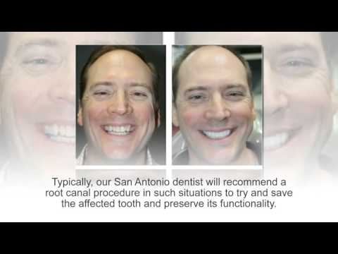 Root Canal Procedures at Cosmetic Dental Associates San Antonio, TX Dental Office