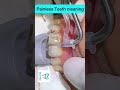 Painless Teeth Cleaning Shots
