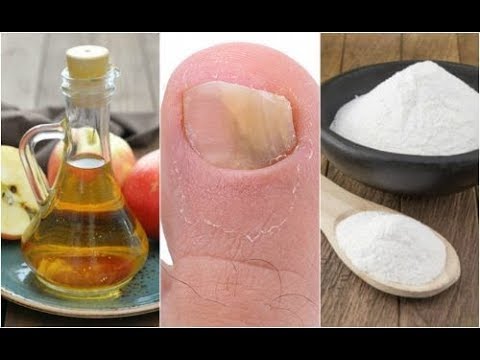 Wie die Candidose des Nagels zu heilen Die Anwendung eksoderila für die Nägel die Rezensionen der Preis die Analoga