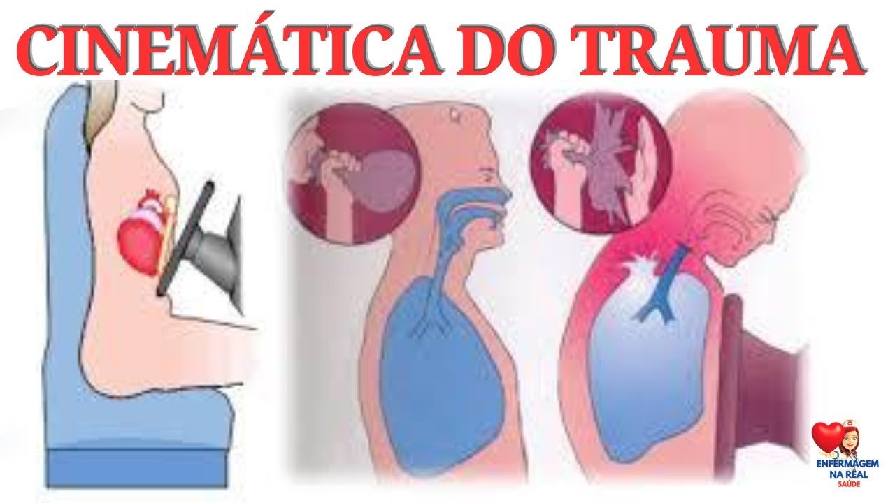 CINEMÁTICA DO TRAUMA: AVALIAÇÃO DA CENA EM ACIDENTES